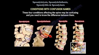 Spondylolysis Spondylolisthesis Spondylitis SpondylosisEverything Need To KnowDr Nabil Ebraheim [upl. by Zerdna]