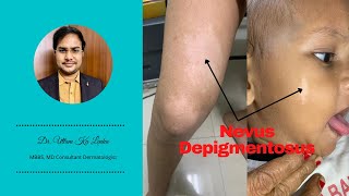 Nevus Depigmentosus  White birth mark and its treatment Skin me safed dag ka karan aur ilaz [upl. by Elatsyrc]