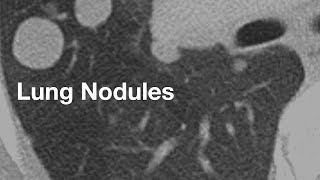 Lung Nodules basics for patients [upl. by Dominik]