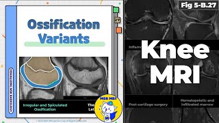 Fig 5B27 Types of Ossification Variants of the Knee [upl. by Arjun]