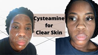 Cysteamine Cream for Clear Skin  Dark Skin [upl. by Rupert677]