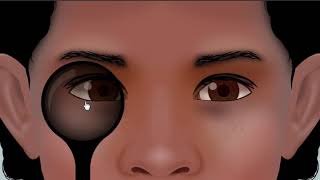 examination of esotropia  animation [upl. by Adhamh]