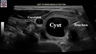 Thyroid cystic nodule treatment by Sean Nikravan MD FACE Thyroid Institute [upl. by God521]