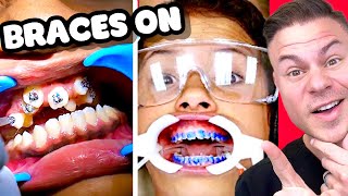 How Braces Are Put On  Watch Before You Get Braces [upl. by Dania]