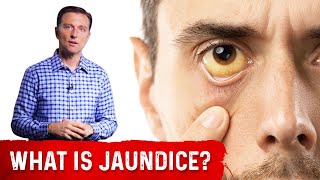 Jaundice Symptoms Explained by DrBerg In Very Simple Terms [upl. by Assenar]