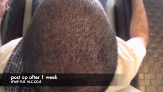 FUE Hair Transplant Hair Transplant Repair Hairline Clinic [upl. by Ahsaz128]