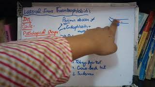 LATERAL SINUS THROMBOPHLEBITIS a complication of Suppurative otitis media part 1 [upl. by Akira448]