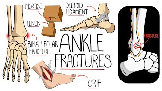 Ankle Fractures Made Easy [upl. by Atikim102]