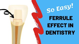 Ferrule effect in dentistry simplified  Dr Teeth [upl. by Niarbo]