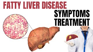 Fatty liver symptoms treatment  Fatty liver disease in Hindi [upl. by Abate]