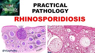 Practical Pathology RHINOSPORIDIOSIS [upl. by Oly]