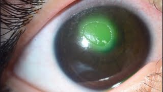 NEUROTROPHIC CORNEAL ULCER [upl. by Fritze]