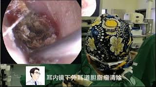 Endoscopic removal of keratosis obturans by Dr Zhao EP1 [upl. by Danaher331]