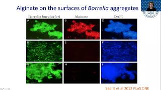 Potential Connection of Borrelia Infection and Breast Cancer Dr Eva Sapi [upl. by Etteniuqna]