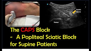 Lateral Popliteal Sciatic Block for Supine Patients CAPS block [upl. by Htiekal]