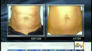 Exilis Body Contouring  Ultrasound Fat Reduction  Exilis Day [upl. by Whalen]