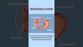 Esophagus cancer I Treatment for Esophagus cancer in Delhi [upl. by Thunell]