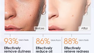 🔴 SKINEVER Salicylic Acid Acne Deep Cleaning Gentle Exfoliating Oil Control Acne Treatment Skin‼️ [upl. by Nomahs253]