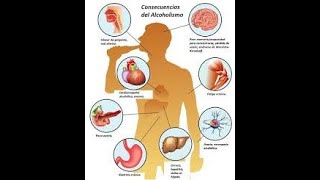 Consecuencias del consumo de alcohol [upl. by Ahsoym844]