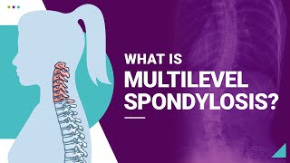 What is Multilevel Spondylosis [upl. by Vey]