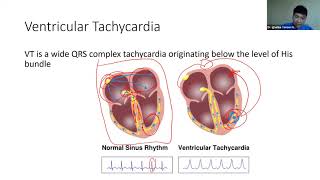 Cara Mendeteksi Takiaritmia oleh Dr Ignatius Yansen NG SpJP K FIHA  ECG Class 4 [upl. by Osbert]