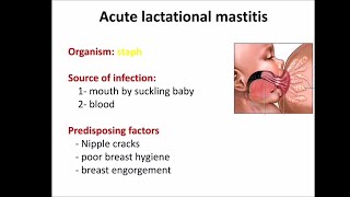 Acute lactational mastitis [upl. by Cima]