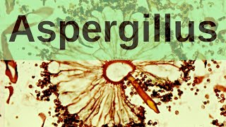 Aspergillus and Aspergillosis  Pathology mini tutorial [upl. by Wenger422]