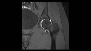 Hip MRI Arthrogram Contrast in Joint Normal No Pathology [upl. by Llebpmac40]