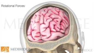 Concussion in Sport Video  Todd Arnold  MedBridge [upl. by Frieder830]