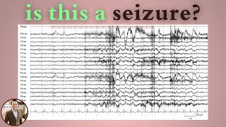 Photomyoclonic Response on EEG Not a Seizure Here’s Why [upl. by Leidgam]