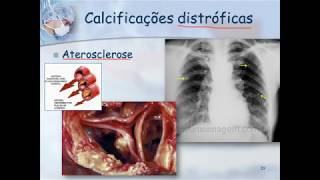 Patologia Geral  Calcificações Patológicas [upl. by Anen]