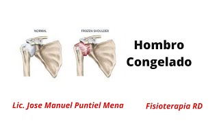 Los mejores Estiramientos y Ejercicios para el Hombro Congelado  FisioterapiaRD [upl. by Ennagroeg]