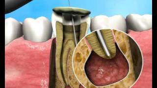 Treatment of Apical Periodontitis  a new approach [upl. by Zeuqram47]