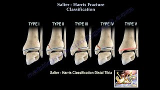 Salter Harris Fracture Classification  Everything You Need To Know  Dr Nabil Ebraheim [upl. by Onavlis636]