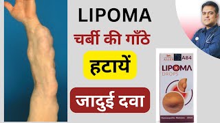 Lipoma ki best homeopathy medicine । लिपोमा ठीक करे बिना ऑपरेशन । [upl. by Burck]