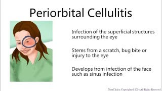 Periorbital cellulitis [upl. by Fernyak]