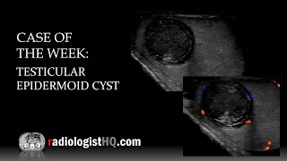 Case of the Week Testicular Epidermoid Cyst Ultrasound [upl. by Darrick]