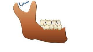 Introduction to equilibration  Occlusal interferences [upl. by Trebleda]