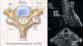 Cervicobraquialgia ¿Cómo interpretar los RX y la electromiografía  Dr Sebastián Celis Molina [upl. by Anitteb]