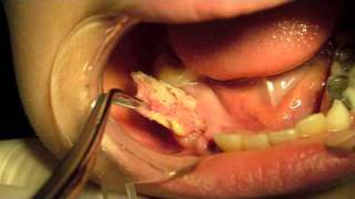 Dentigerous Cyst Marsupialization [upl. by Trow359]