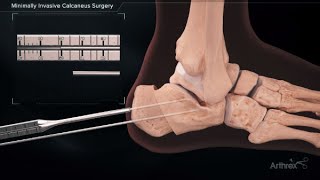 Minimally Invasive Calcaneus Surgery [upl. by Anailli856]