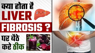 क्या होता है liver fibrosis घर बैठे करे ठीक  Liver Fibrosis Causes and Treatment  SRIAAS [upl. by Kcub273]