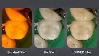 ORMED Filter Introduction  Optimal Light Source in Composite Restoration Short Version [upl. by Ayyn]