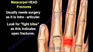 Metacarpal Fractures  Everything You Need To Know  Dr Nabil Ebraheim [upl. by Aras562]