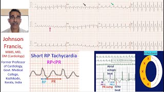 Narrow QRS Tachycardia Mechanism [upl. by Sisi]