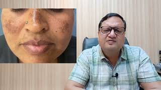 Pigmentation Treatment Price  Laser Pigmentation Treatment  Causes  Kayakalp Laser Clinic [upl. by Demmer237]