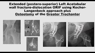 Tension band and cerclage wiring techniques for fracture fixation [upl. by Verne]