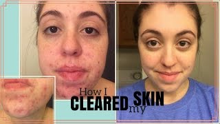 HOW I CLEARED MY SKIN  My Journey with Curology [upl. by Fiertz]