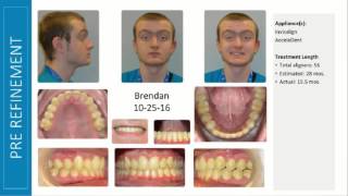 Dr Manal Ibrahim Invisalign Case Review Intrusion with AcceleDent [upl. by Alleda]