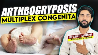 Understanding Arthrogryposis Multiplex Congenita Causes Symptoms and Treatment Options [upl. by Erised]